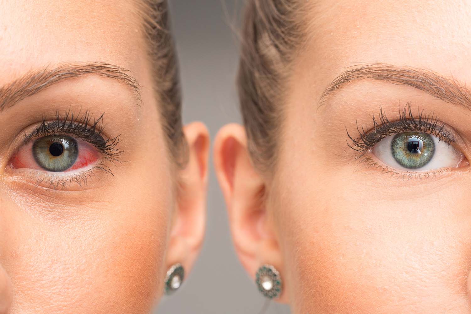 Person with red eyes and person with clear eyes side-by-side